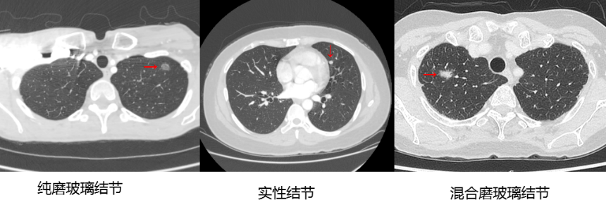 【高新轉(zhuǎn)載】肺結(jié)節(jié)與肺癌有的區(qū)別在哪呢？