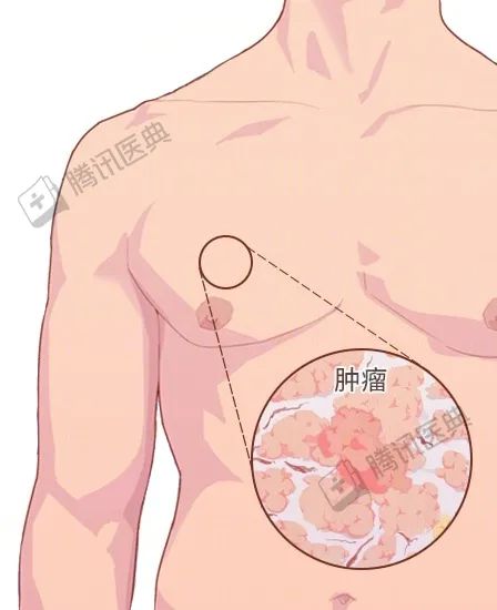 男人很容易忽視的一種癌，確診大多是晚期