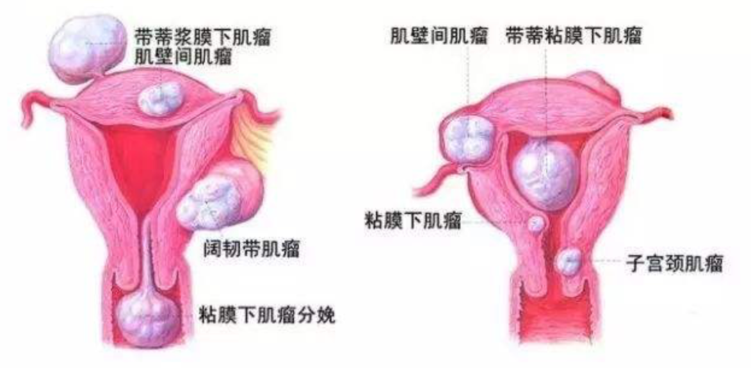 子宮肌瘤不開刀的治療方式——子宮動(dòng)脈栓塞術(shù)