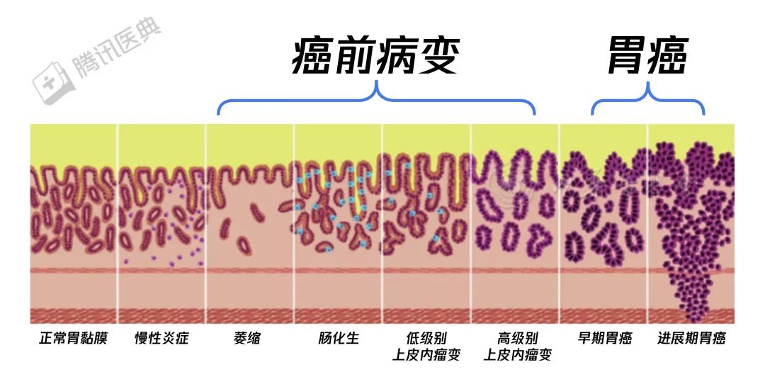 胃癌來臨前，會經(jīng)歷這個階段！千萬別不當(dāng)回事