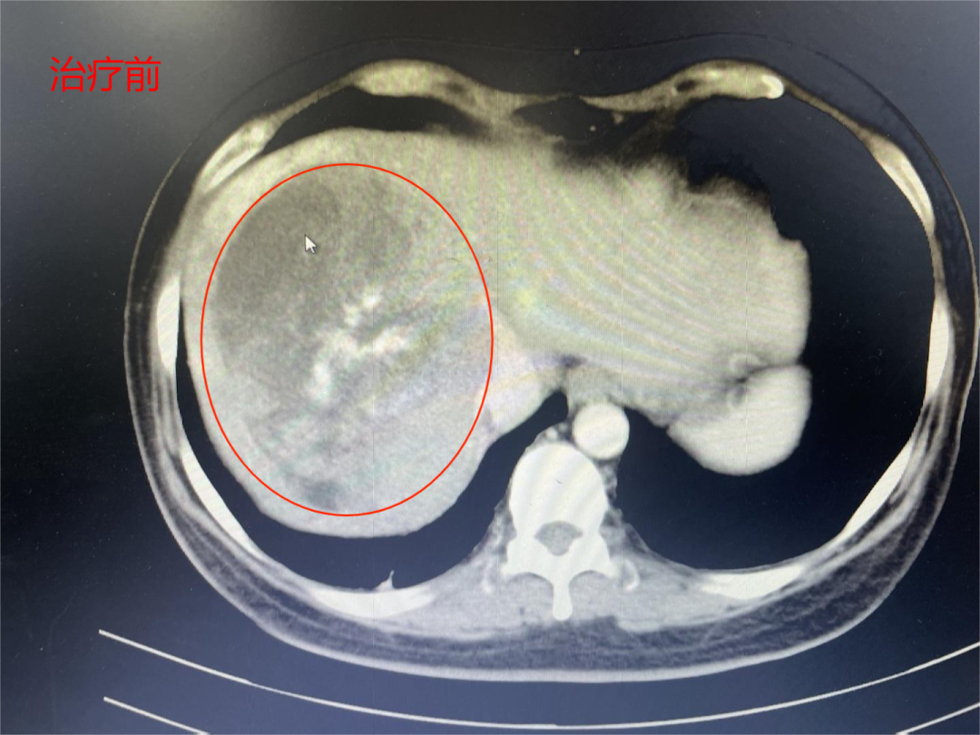 【肝癌巨型腫瘤】甲胎蛋白值高達(dá)11萬(wàn)，介入7個(gè)療程，甲胎蛋白降至32