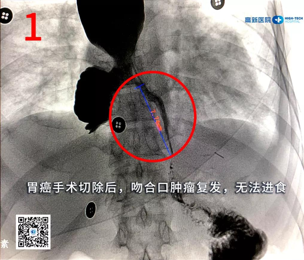 【胃癌】一位胃癌晚期患者從命懸一線(xiàn)到正常生活，幸運(yùn)絕非偶然！